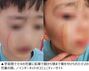 学習塾で授業中に鉛筆で額から顎まで引っかかれた小2児童、傷跡の写真に韓国ネット民憤慨